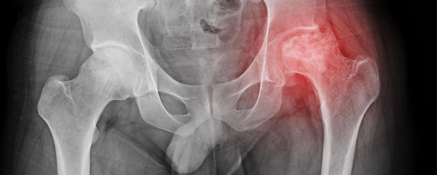 Avascular Necrosis of the Hip Avascular Necrosis of the Hip